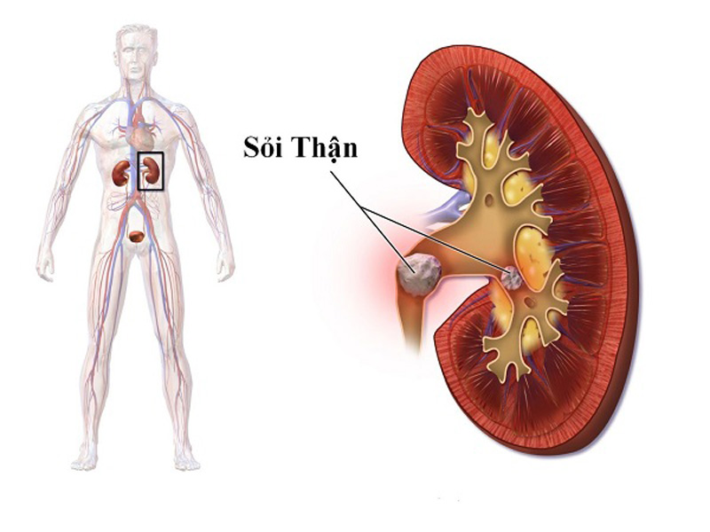 Dấu hiệu Sỏi thận