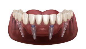 Trồng Răng Implant Là Gì? Ưu Nhược Điểm, Chi Phí