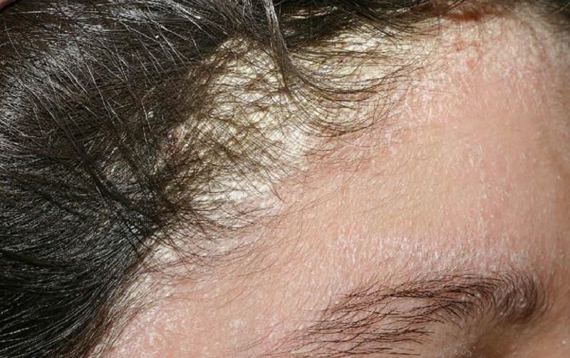 Viêm da tiết bã da đầu là một trong những dạng phổ biến nhất ở bệnh viêm da tiết bã