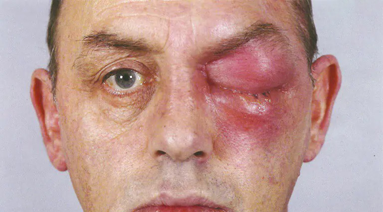 Viêm mô tế bào hốc mắt là biến chứng nguy hiểm của bệnh