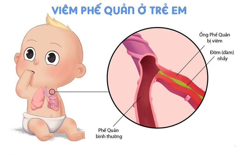 viêm phế quản ở trẻ em