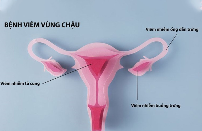 Dịch tiết âm đạo bất thường là dấu hiệu của viêm vùng chậu