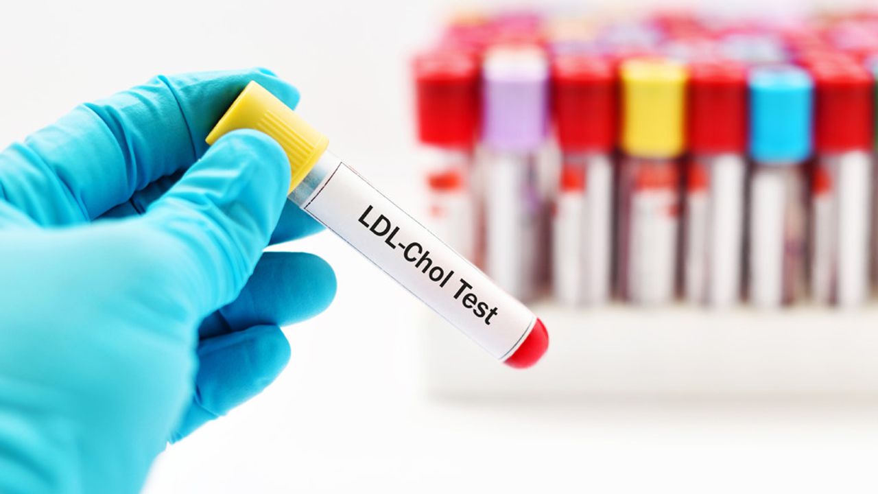 Chỉ số mỡ máu LDL - Cholesterol
