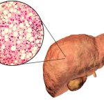 Gan Nhiễm Mỡ Là Gì? Biểu Hiện Và Cách Điều Trị Hiệu Quả