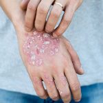 Bệnh Chàm Eczema – Nguyên Nhân, Triệu Chứng, Cách Điều Trị