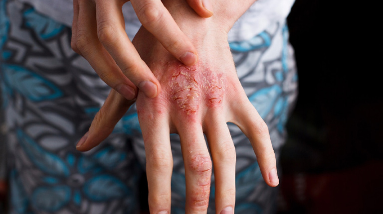 Viêm da cơ địa (Atopic Dermatitis - AD) là một bệnh lý viêm da mãn tính thường gặp