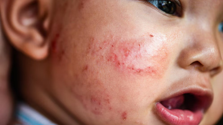 Bệnh Eczema Ở Trẻ Sơ Sinh Và Các Phương Pháp Điều Trị