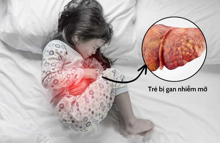 Gan nhiễm mỡ ở trẻ em xảy ra khi có nhiều chất béo tích tụ trong gan