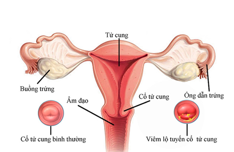 Viêm lộ tuyến cổ tử cung là bệnh lý phụ khoa thường gặp