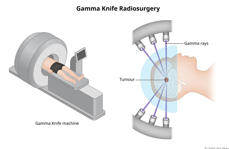 Kết quả ứng dụng kỹ thuật xạ phẫu dao Gamma quay trong điều trị u não tại Thái Nguyên