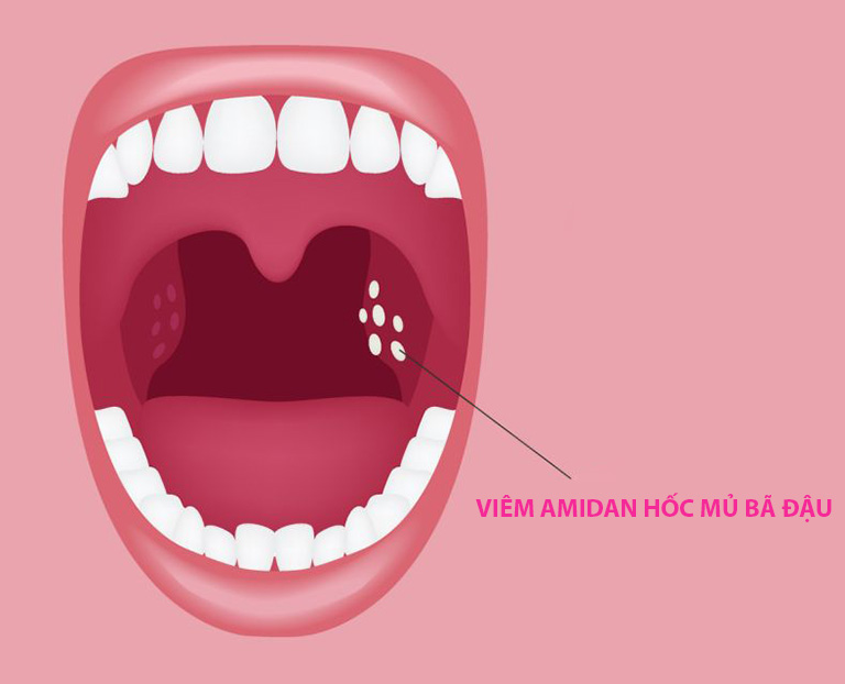 Viêm Amidan Hốc Mủ Bã Đậu