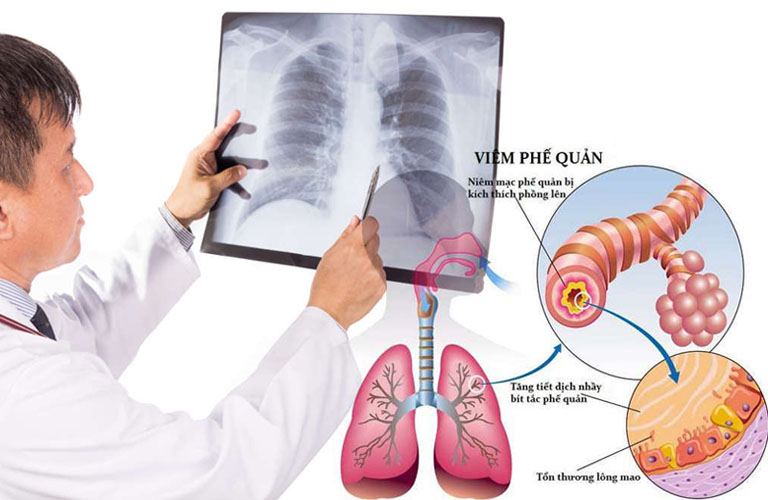 Viêm Phế Quản Cấp Do Đâu? Cách Điều Trị Dứt Điểm