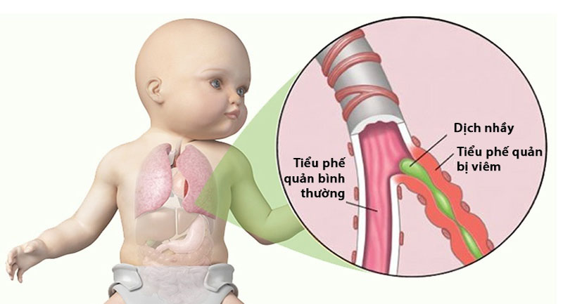 Viêm tiểu phế quản bội nhiễm thường gặp nhất ở trẻ nhỏ