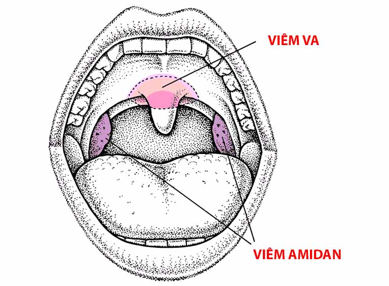 Viêm Va Và Viêm Amidan Khác Nhau Ra Sao? Bệnh Nào Nguy Hiểm?