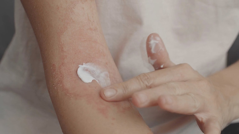 Bệnh eczema có chữa khỏi được không