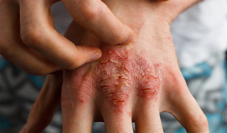 Bệnh eczema có lây không?