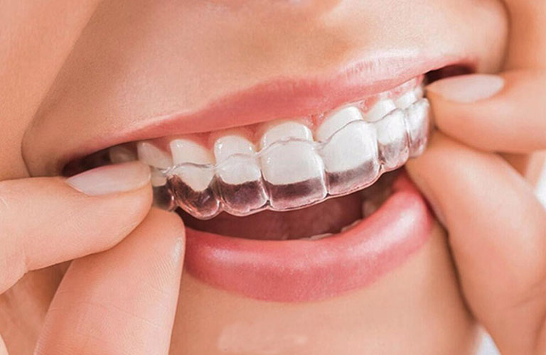 Niềng răng Invisalign là phương pháp chỉnh nha hiện đại