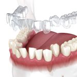 Niềng Răng Invisalign: Ưu Nhược Điểm, Quy Trình Thực Hiện