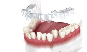 Niềng Răng Invisalign: Ưu Nhược Điểm, Quy Trình Thực Hiện