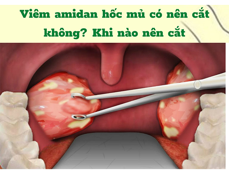 Viêm amidan hốc mủ có nên cắt không