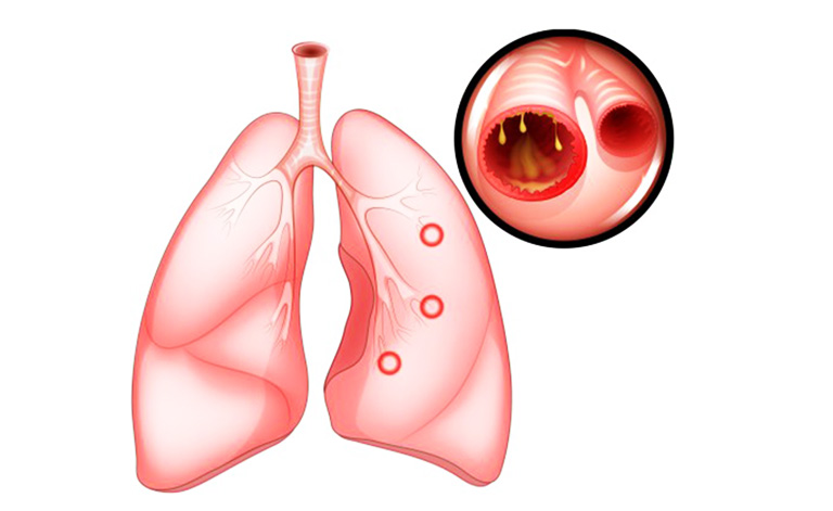 Viêm phế quản có lây không là từ khóa được khá nhiều tìm kiếm để đi tìm câu trả lời chuẩn xác