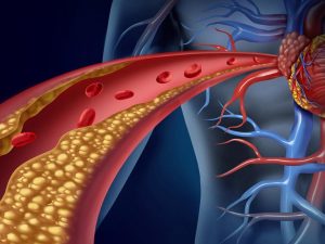 Tăng Cholesterol: Nguyên Nhân, Dấu Hiệu Và Cách Điều Trị