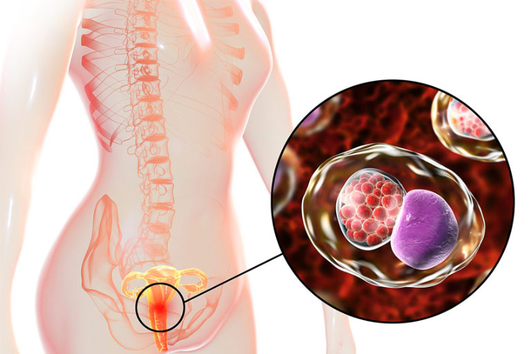 Viêm m Đạo Do Vi Khuẩn: Biểu Hiện & Cách Điều Trị Hiệu Quả Nhất