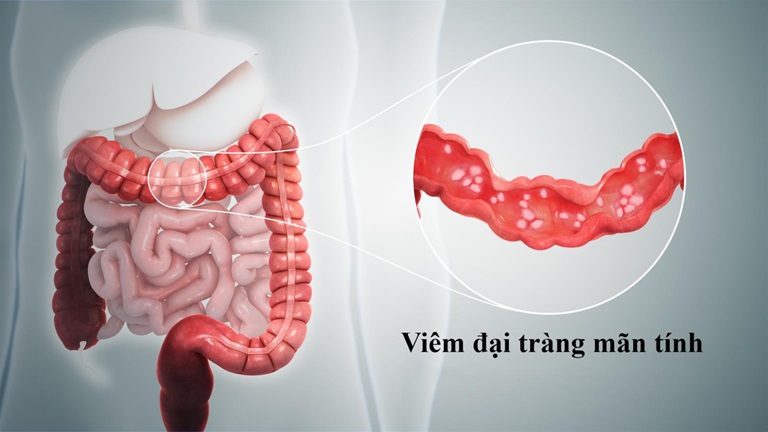 Viêm đại tràng mãn tính là tình trạng viêm kéo dài ở lớp niêm mạc của đại tràng