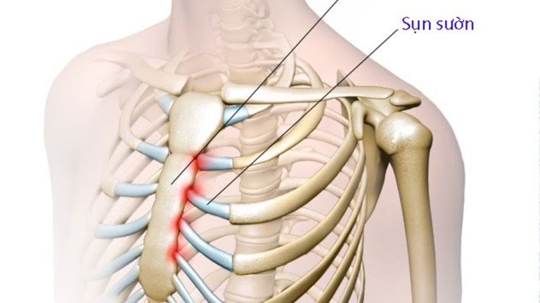 Viêm Khớp Ức Sườn Là Gì? Dấu Hiệu Nhận Biết Và Cách Chữa