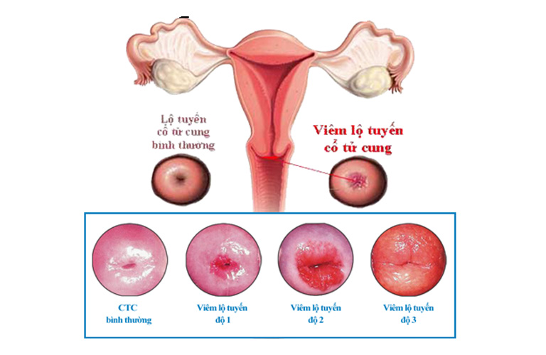 Viêm lộ tuyến độ 2 có diện tích viêm chiếm 2/3 bề mặt cổ tử cung