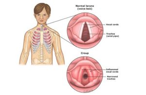 Viêm Thanh Khí Phế Quản Cấp Do Đâu? Triệu Chứng, Cách Chữa